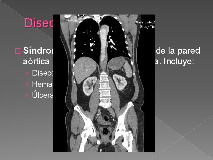Disección de Aorta � Síndrome aórtico agudo: lesión de la pared aórtica que afecta Disección de Aorta � Síndrome aórtico agudo: lesión de la pared aórtica que afecta