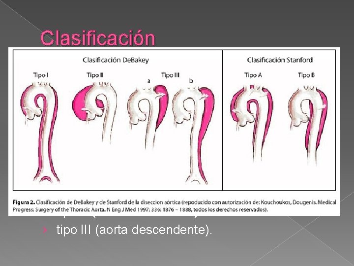 Clasificación � Clasificación de Stanford : › Tipo A (cuando afecta a la aorta Clasificación � Clasificación de Stanford : › Tipo A (cuando afecta a la aorta