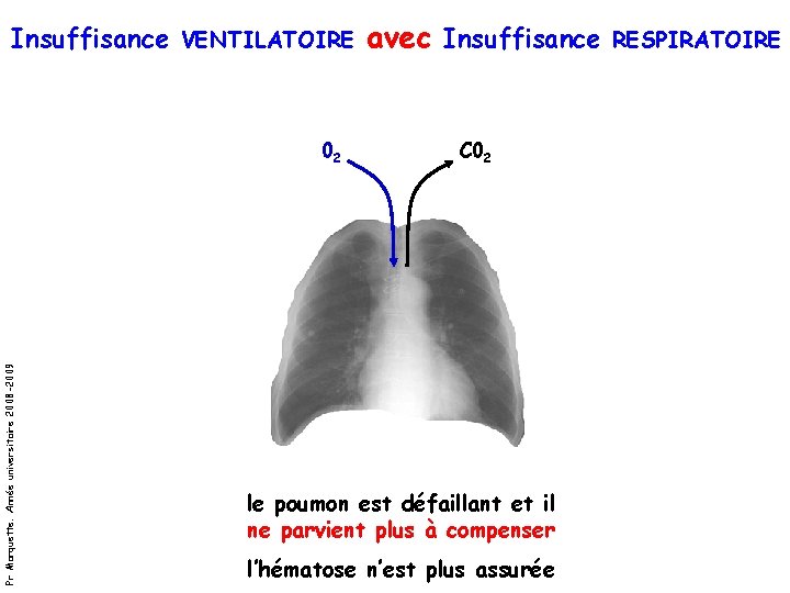 Insuffisance VENTILATOIRE avec Insuffisance RESPIRATOIRE Pr Marquette. Année universitaire 2008 -2009 02 C 02