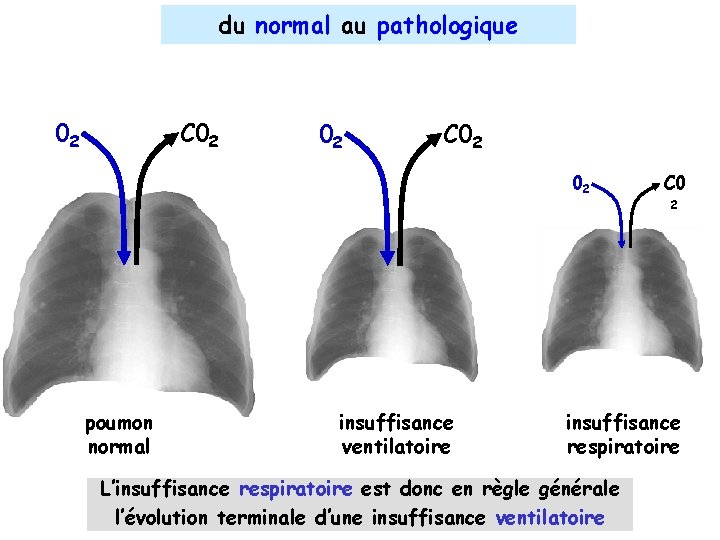 du normal au pathologique 02 C 02 02 poumon normal insuffisance ventilatoire C 0