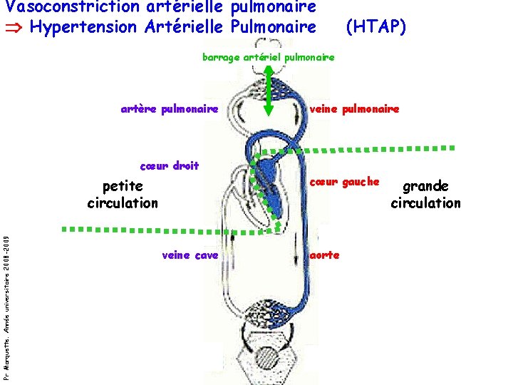 Vasoconstriction artérielle pulmonaire Hypertension Artérielle Pulmonaire (HTAP) barrage artériel pulmonaire artère pulmonaire veine pulmonaire