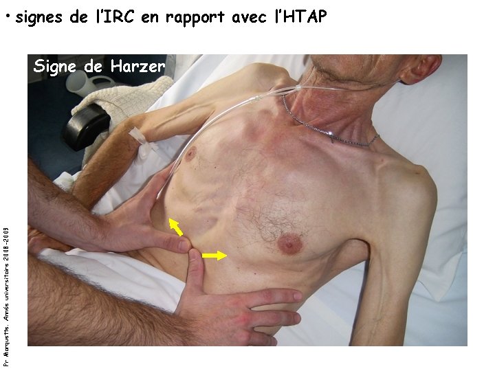  • signes de l’IRC en rapport avec l’HTAP Pr Marquette. Année universitaire 2008
