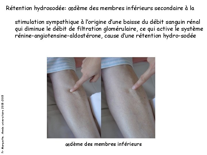 Rétention hydrosodée: œdème des membres inférieurs secondaire à la Pr Marquette. Année universitaire 2008