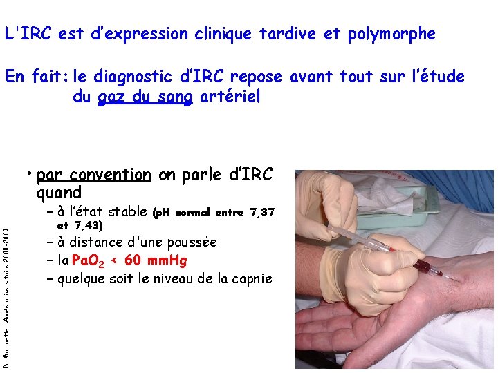 L'IRC est d’expression clinique tardive et polymorphe En fait: le diagnostic d’IRC repose avant