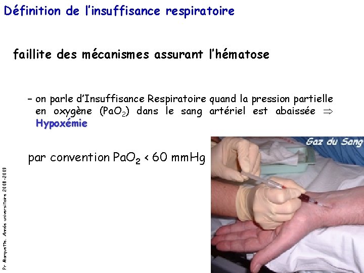 Définition de l’insuffisance respiratoire faillite des mécanismes assurant l’hématose – on parle d’Insuffisance Respiratoire