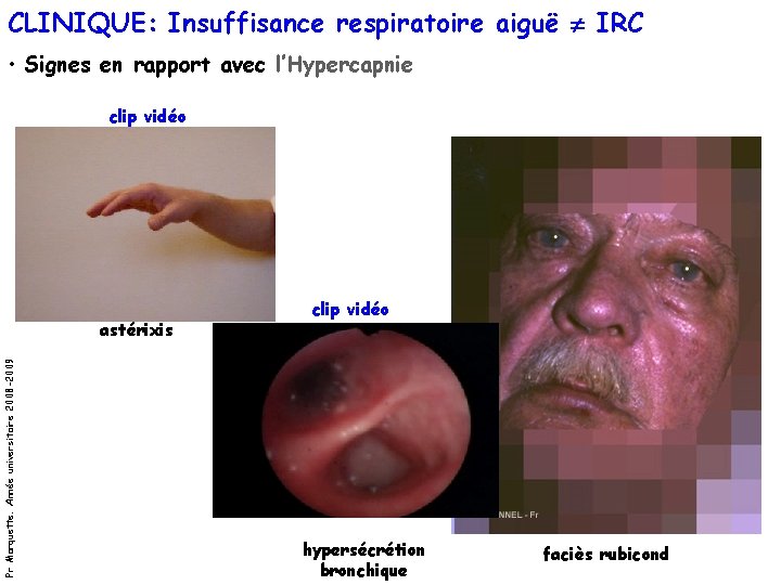 CLINIQUE: Insuffisance respiratoire aiguë IRC • Signes en rapport avec l’Hypercapnie clip vidéo Pr