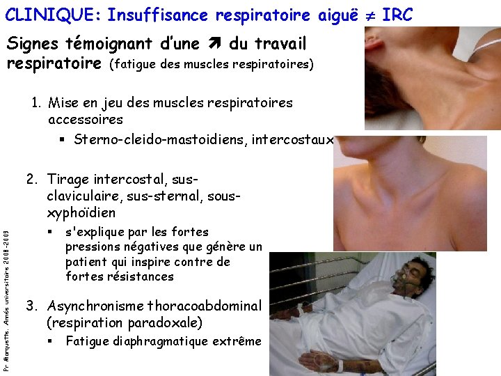 CLINIQUE: Insuffisance respiratoire aiguë IRC Signes témoignant d’une du travail respiratoire (fatigue des muscles