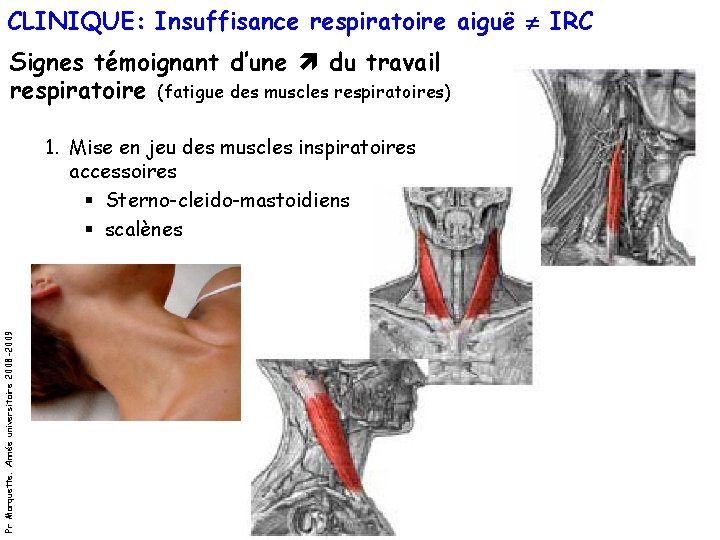 CLINIQUE: Insuffisance respiratoire aiguë IRC Signes témoignant d’une du travail respiratoire (fatigue des muscles