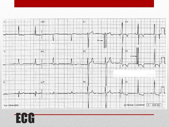 ECG 