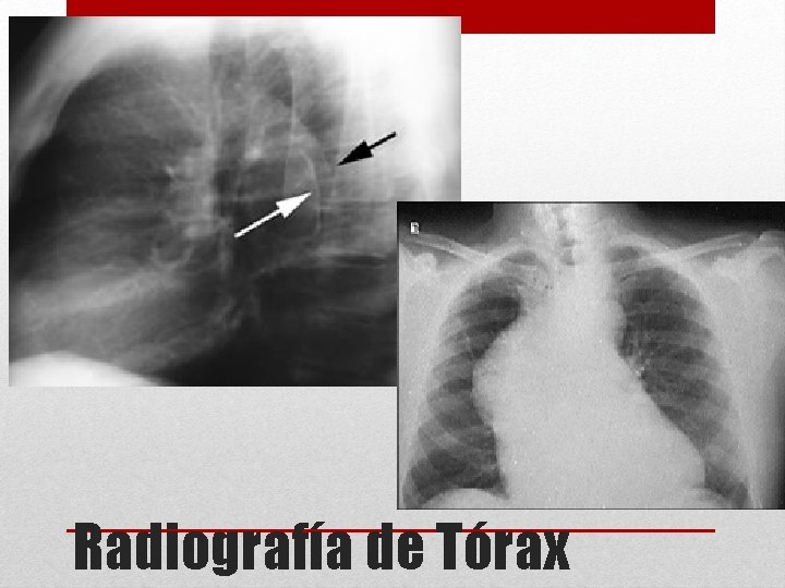 Radiografía de Tórax 