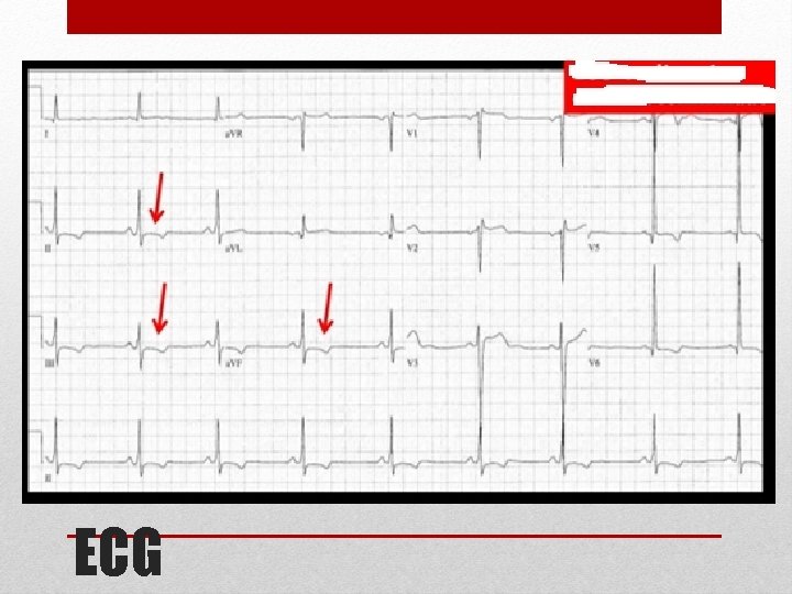 ECG 