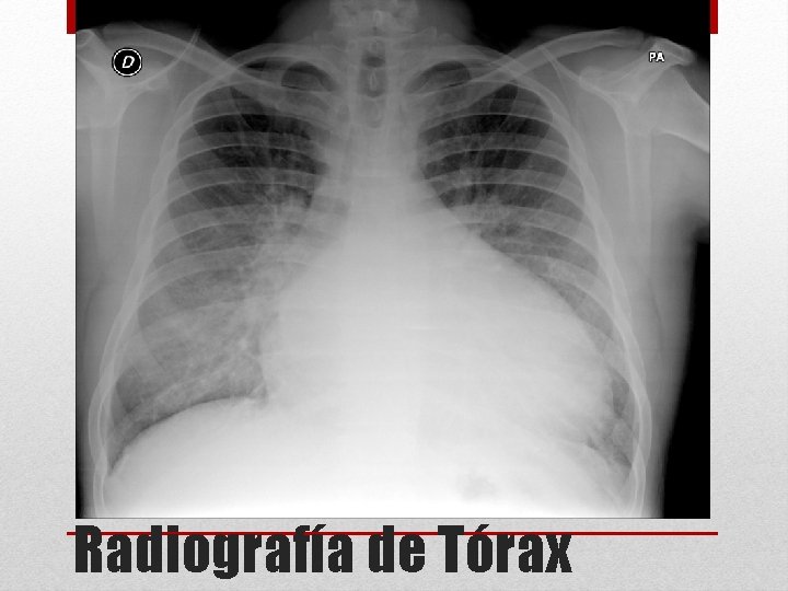 Radiografía de Tórax 