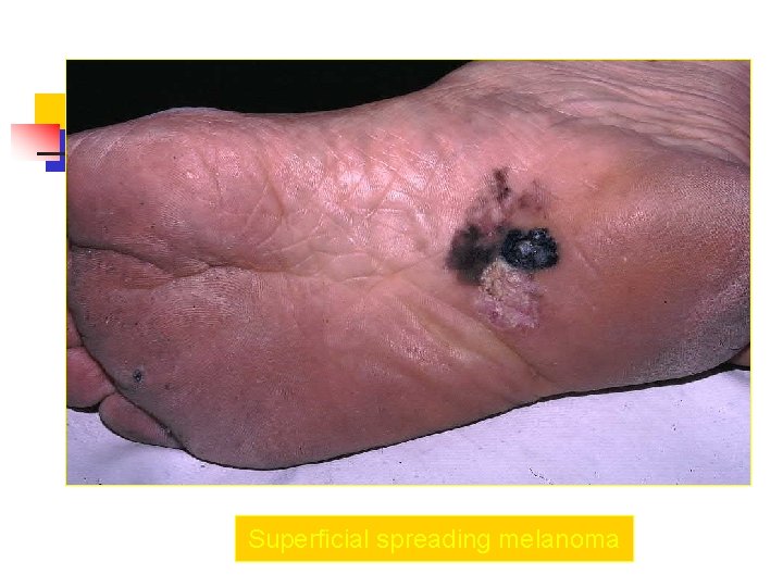 Superficial spreading melanoma 