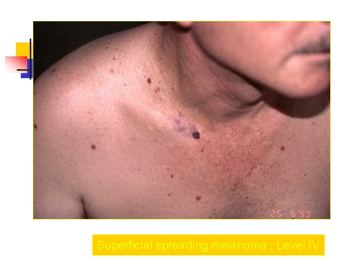 Superficial spreading melanoma ; Level IV 