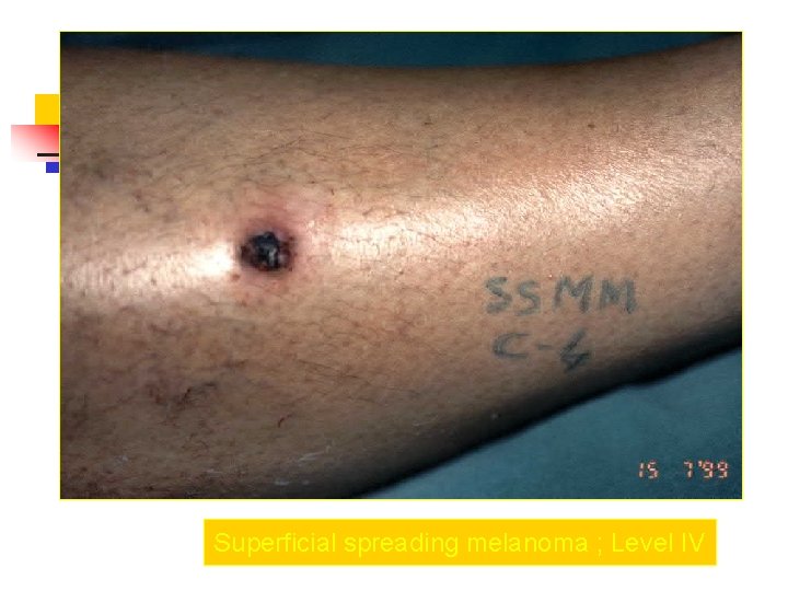Superficial spreading melanoma ; Level IV 