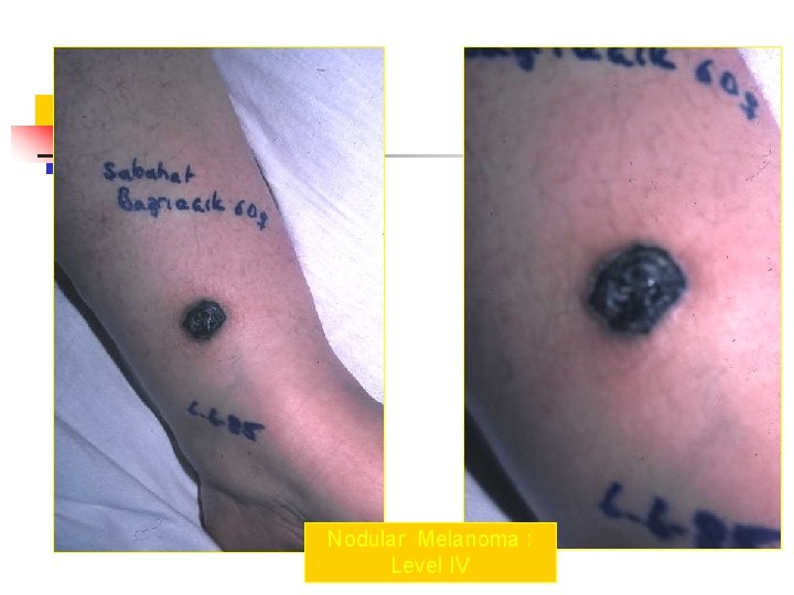 Nodular Melanoma : Level IV 