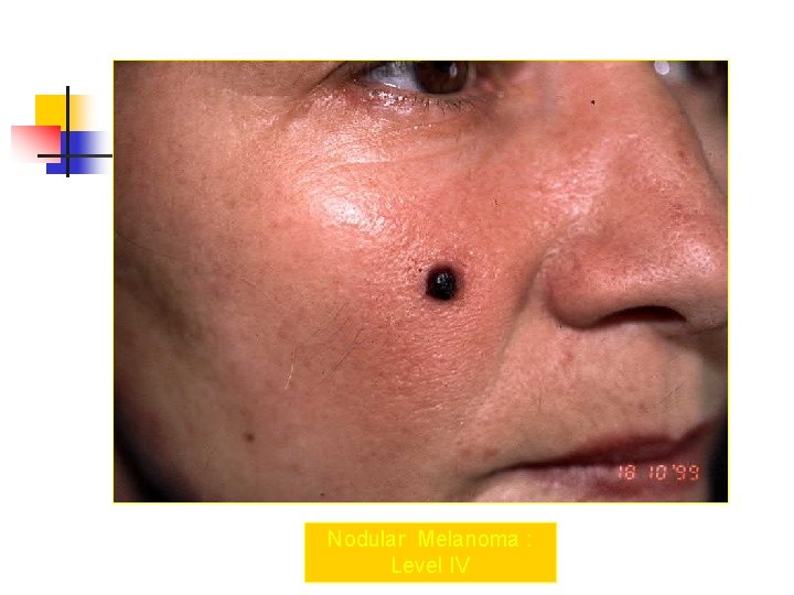 Nodular Melanoma : Level IV 