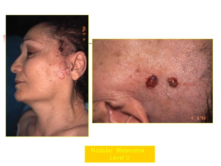 Nodular Melanoma : Level V 