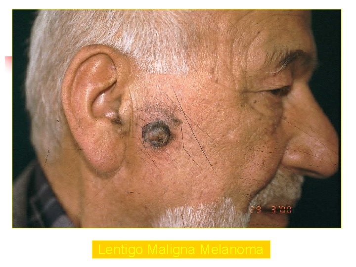 Lentigo Maligna Melanoma 