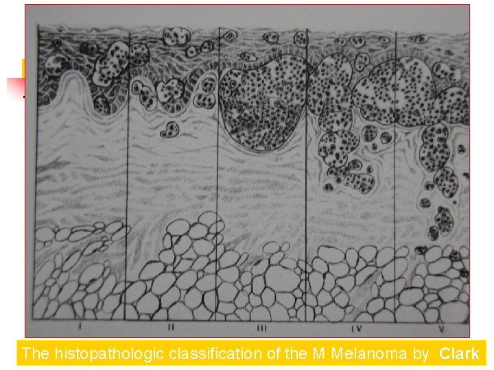 The histopathologic classification of the M Melanoma by Clark 