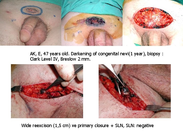 AK, E, 47 years old. Darkening of congenital nevi(1 year), biopsy : Clark Level