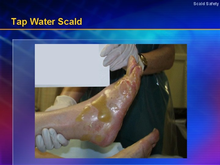 Scald Safety Tap Water Scald 