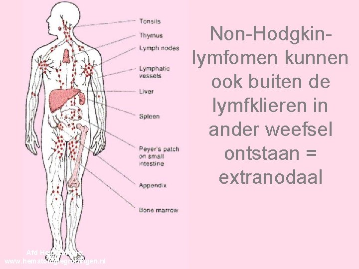 Non-Hodgkinlymfomen kunnen ook buiten de lymfklieren in ander weefsel ontstaan = extranodaal Afd Hematologie;