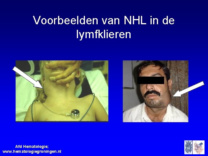 Voorbeelden van NHL in de lymfklieren Afd Hematologie; www. hematologiegroningen. nl 