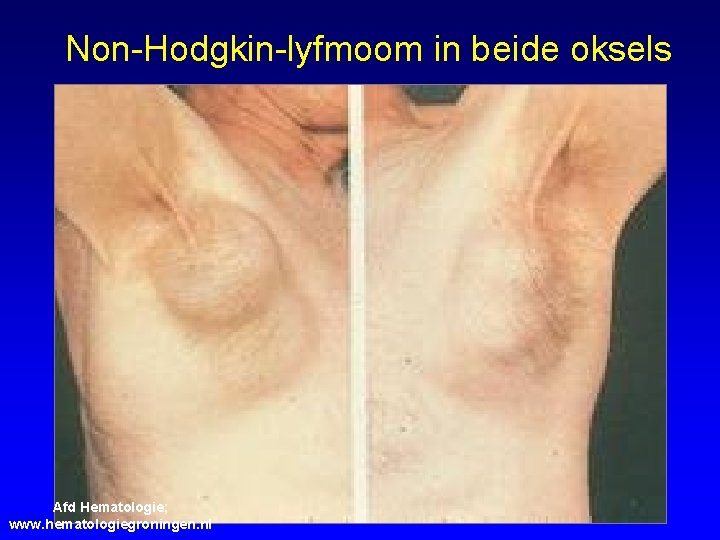 Non-Hodgkin-lyfmoom in beide oksels Afd Hematologie; www. hematologiegroningen. nl 