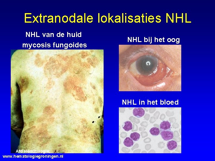 Extranodale lokalisaties NHL van de huid mycosis fungoides NHL bij het oog NHL in