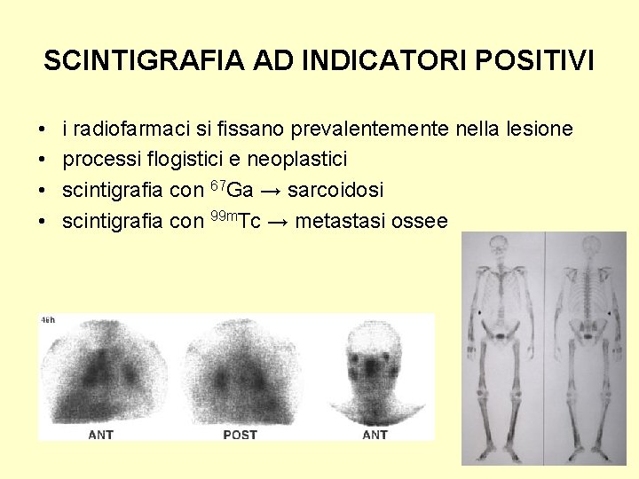 SCINTIGRAFIA AD INDICATORI POSITIVI • • i radiofarmaci si fissano prevalentemente nella lesione processi