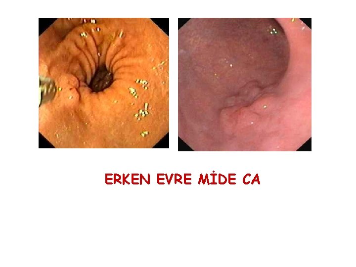 ERKEN EVRE MİDE CA ERKEN EVRE MİDE CA
