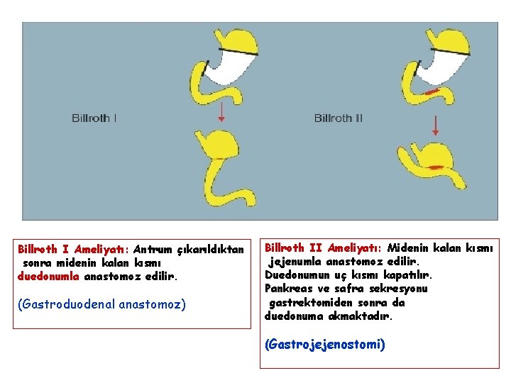 Billroth I Ameliyatı: Antrum çıkarıldıktan sonra midenin kalan kısmı duedonumla anastomoz edilir. (Gastroduodenal anastomoz) Billroth I Ameliyatı: Antrum çıkarıldıktan sonra midenin kalan kısmı duedonumla anastomoz edilir. (Gastroduodenal anastomoz)