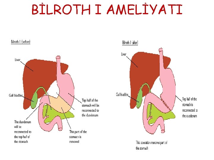 BİLROTH I AMELİYATI BİLROTH I AMELİYATI