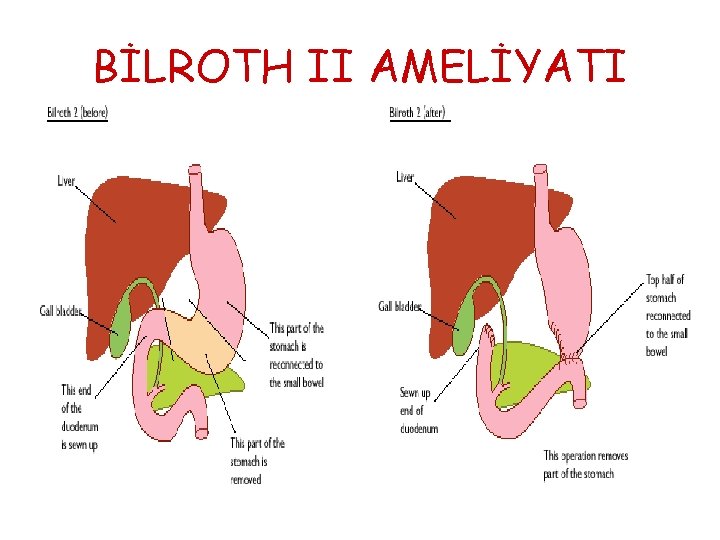 BİLROTH II AMELİYATI BİLROTH II AMELİYATI