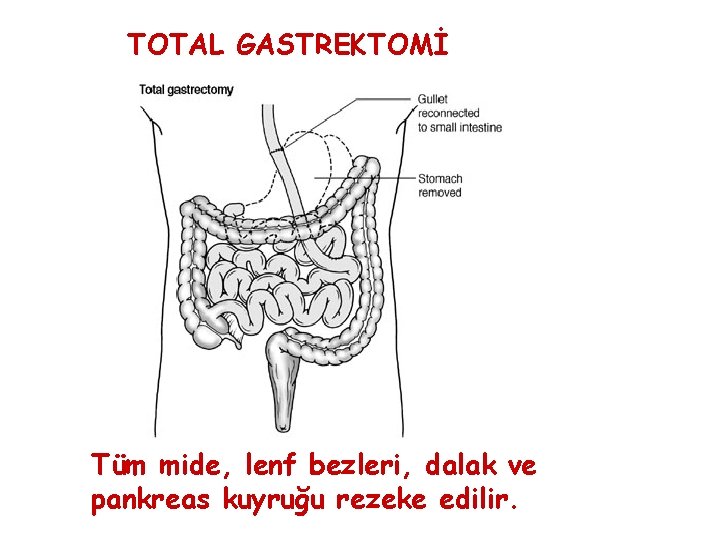 TOTAL GASTREKTOMİ Tüm mide, lenf bezleri, dalak ve pankreas kuyruğu rezeke edilir. TOTAL GASTREKTOMİ Tüm mide, lenf bezleri, dalak ve pankreas kuyruğu rezeke edilir.
