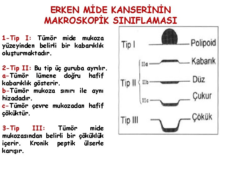 ERKEN MİDE KANSERİNİN MAKROSKOPİK SINIFLAMASI 1 -Tip I: Tümör mide mukoza yüzeyinden belirli bir ERKEN MİDE KANSERİNİN MAKROSKOPİK SINIFLAMASI 1 -Tip I: Tümör mide mukoza yüzeyinden belirli bir