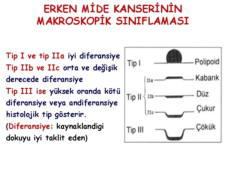 ERKEN MİDE KANSERİNİN MAKROSKOPİK SINIFLAMASI Tip I ve tip IIa iyi diferansiye Tip IIb ERKEN MİDE KANSERİNİN MAKROSKOPİK SINIFLAMASI Tip I ve tip IIa iyi diferansiye Tip IIb