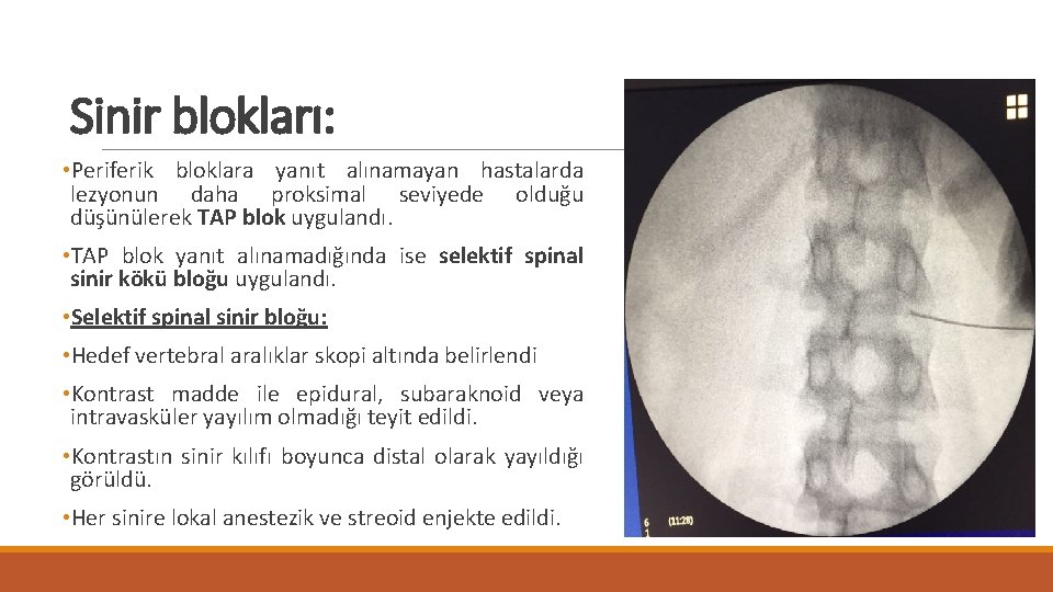 Sinir blokları: • Periferik bloklara yanıt alınamayan hastalarda lezyonun daha proksimal seviyede olduğu düşünülerek Sinir blokları: • Periferik bloklara yanıt alınamayan hastalarda lezyonun daha proksimal seviyede olduğu düşünülerek