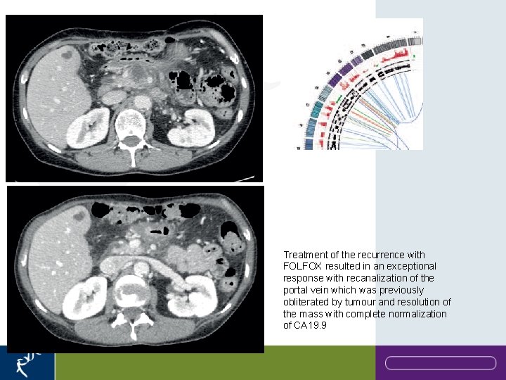 Treatment of the recurrence with FOLFOX resulted in an exceptional response with recanalization of