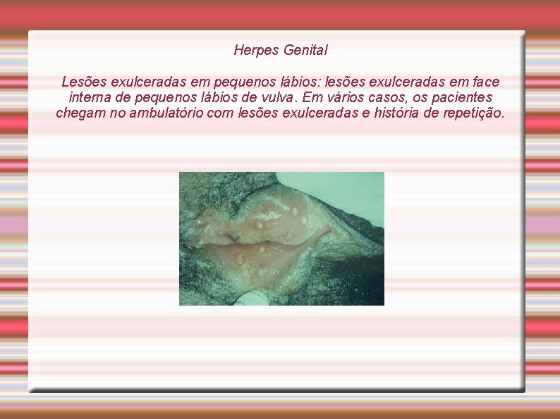 Herpes Genital Lesões exulceradas em pequenos lábios: lesões exulceradas em face interna de pequenos