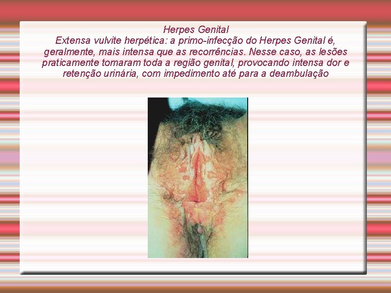 Herpes Genital Extensa vulvite herpética: a primo-infecção do Herpes Genital é, geralmente, mais intensa