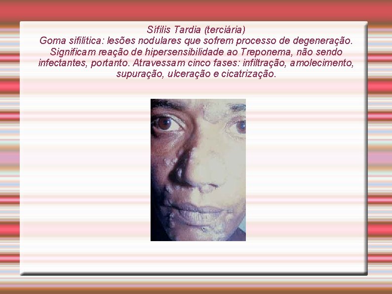Sífilis Tardia (terciária) Goma sifilítica: lesões nodulares que sofrem processo de degeneração. Significam reação Sífilis Tardia (terciária) Goma sifilítica: lesões nodulares que sofrem processo de degeneração. Significam reação