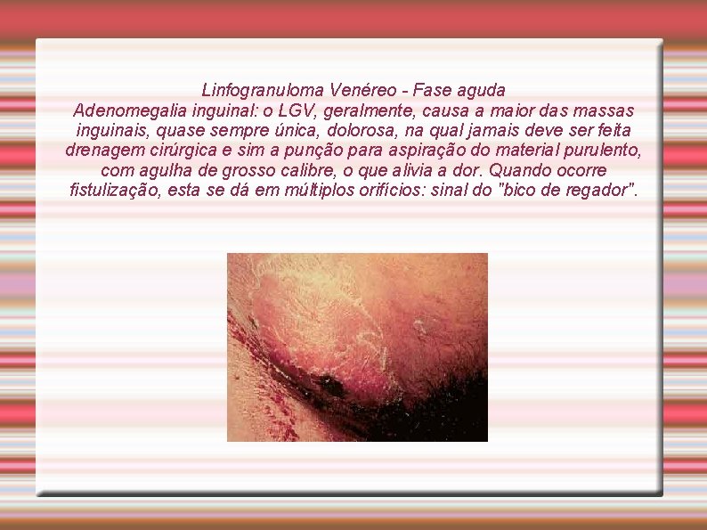 Linfogranuloma Venéreo - Fase aguda Adenomegalia inguinal: o LGV, geralmente, causa a maior das