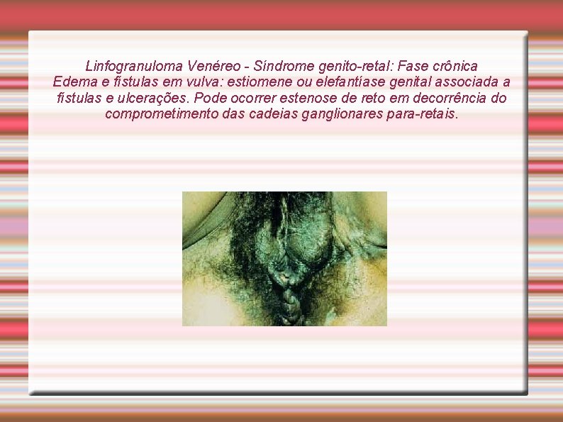 Linfogranuloma Venéreo - Síndrome genito-retal: Fase crônica Edema e fístulas em vulva: estiomene ou