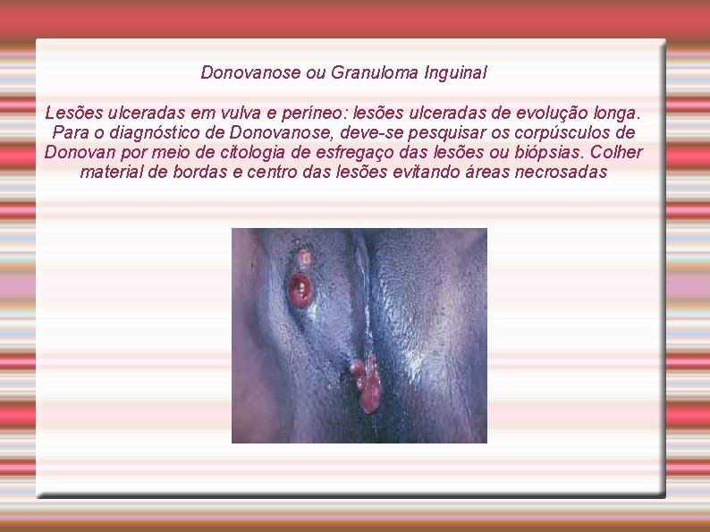 Donovanose ou Granuloma Inguinal Lesões ulceradas em vulva e períneo: lesões ulceradas de evolução