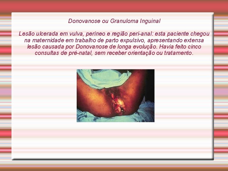 Donovanose ou Granuloma Inguinal Lesão ulcerada em vulva, períneo e região peri-anal: esta paciente