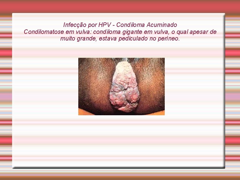 Infecção por HPV - Condiloma Acuminado Condilomatose em vulva: condiloma gigante em vulva, o