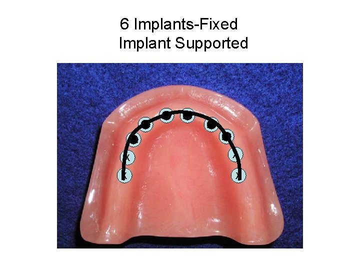 6 Implants-Fixed Implant Supported 23 22 X X 24 25 26 27 X X