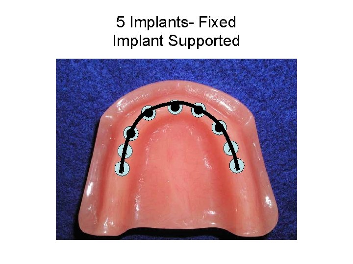 5 Implants- Fixed Implant Supported B A X X C D E X X